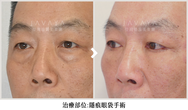 Before|看起來疲憊沒睡飽。 After|看起來年輕有精神多了